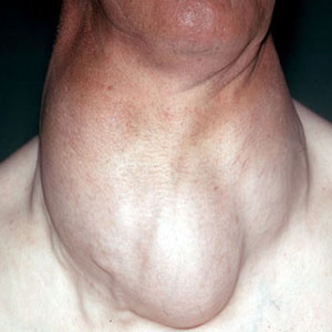 http://www.your-doctor.net/images/endocrine/thyroid/Goiter.jpg