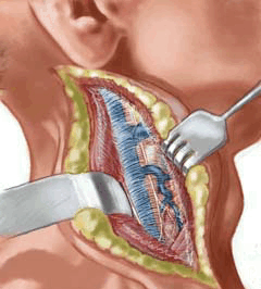 The muscle is bluntly dissected off the loose underlying carotid sheath exposing the internal jugular vein.