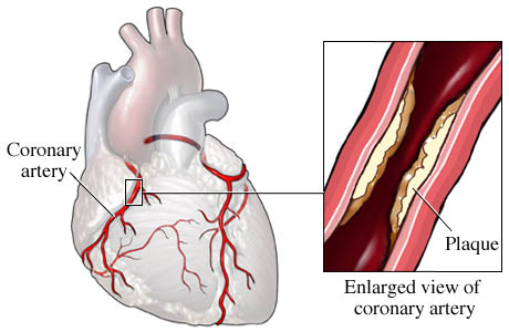 Illustration of Coronary artery disease